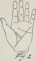 Picture 43 of 65 from Revelations of the hand. A scientific study of the shape and markings of the hand, as an index to character, disease, and tendencies, with explanatory illustrations (1900), leaf 154