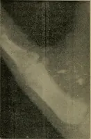 An illustration from The Röntgen rays in medical work (1899)