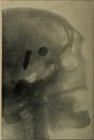 An illustration from The Röntgen rays in medical work (1899)