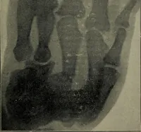 An illustration from The Röntgen rays in medical work (1899)