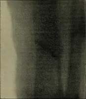 An illustration from The Röntgen rays in medical work (1899)