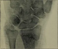 An illustration from The Röntgen rays in medical work (1899)