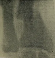 An illustration from The Röntgen rays in medical work (1899)