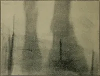 An illustration from The Röntgen rays in medical work (1899)