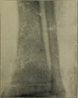 An illustration from The Röntgen rays in medical work (1899)