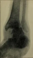 An illustration from The Röntgen rays in medical work (1899)