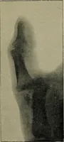 An illustration from The Röntgen rays in medical work (1899)