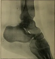 An illustration from The Röntgen rays in medical work (1899)
