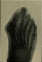 An illustration from The Röntgen rays in medical work (1899)