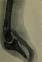 An illustration from The Röntgen rays in medical work (1899)