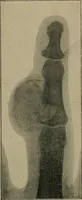 An illustration from The Röntgen rays in medical work (1899)
