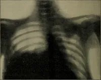 An illustration from The Röntgen rays in medical work (1899)