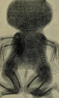 An illustration from The Röntgen rays in medical work (1899)