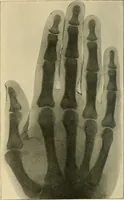 Picture 61 of 147 from The Röntgen rays in medical work (1907), leaf 143