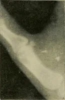 Picture 65 of 147 from The Röntgen rays in medical work (1907), leaf 159