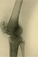 An illustration from The Röntgen rays in medical work (1907)