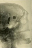 Picture 69 of 147 from The Röntgen rays in medical work (1907), leaf 165