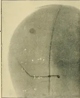 Picture 70 of 147 from The Röntgen rays in medical work (1907), leaf 167