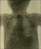 Picture 72 of 147 from The Röntgen rays in medical work (1907), leaf 179