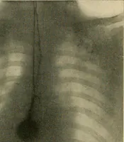 An illustration from The Röntgen rays in medical work (1907)