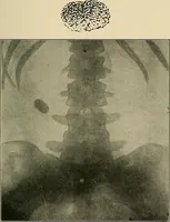 Picture 78 of 147 from The Röntgen rays in medical work (1907), leaf 198