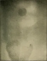 Picture 79 of 147 from The Röntgen rays in medical work (1907), leaf 200