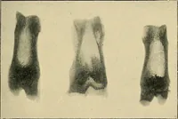 Picture 80 of 147 from The Röntgen rays in medical work (1907), leaf 202