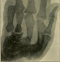 Picture 81 of 147 from The Röntgen rays in medical work (1907), leaf 205