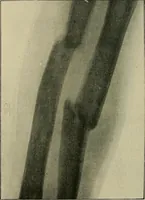 An illustration from The Röntgen rays in medical work (1907)