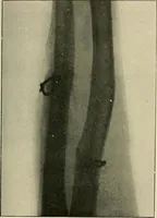 Picture 84 of 147 from The Röntgen rays in medical work (1907), leaf 212