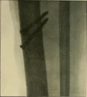 Picture 85 of 147 from The Röntgen rays in medical work (1907), leaf 213