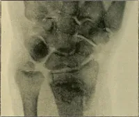 Picture 86 of 147 from The Röntgen rays in medical work (1907), leaf 221