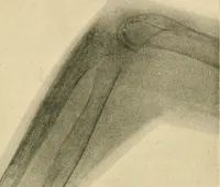 Picture 87 of 147 from The Röntgen rays in medical work (1907), leaf 226