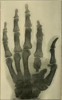 Picture 88 of 147 from The Röntgen rays in medical work (1907), leaf 229