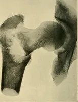 Picture 91 of 147 from The Röntgen rays in medical work (1907), leaf 235
