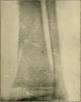 Picture 95 of 147 from The Röntgen rays in medical work (1907), leaf 240