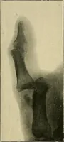 Picture 101 of 147 from The Röntgen rays in medical work (1907), leaf 255