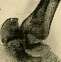 An illustration from The Röntgen rays in medical work (1907)