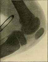 Picture 110 of 147 from The Röntgen rays in medical work (1907), leaf 266