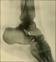 Picture 112 of 147 from The Röntgen rays in medical work (1907), leaf 269