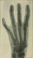 Picture 113 of 147 from The Röntgen rays in medical work (1907), leaf 271