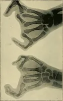 Picture 115 of 147 from The Röntgen rays in medical work (1907), leaf 273