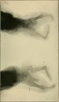 Picture 116 of 147 from The Röntgen rays in medical work (1907), leaf 274
