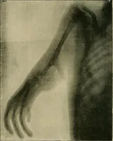 Picture 117 of 147 from The Röntgen rays in medical work (1907), leaf 275