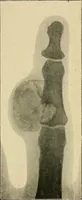 Picture 120 of 147 from The Röntgen rays in medical work (1907), leaf 284