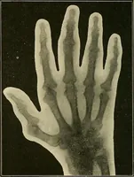 Picture 122 of 147 from The Röntgen rays in medical work (1907), leaf 287