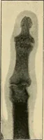 Picture 123 of 147 from The Röntgen rays in medical work (1907), leaf 292
