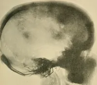 Picture 130 of 147 from The Röntgen rays in medical work (1907), leaf 314