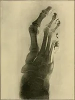 Picture 133 of 147 from The Röntgen rays in medical work (1907), leaf 320