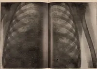 Picture 139 of 147 from The Röntgen rays in medical work (1907), leaf 356